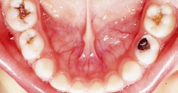 تعرف على فاكهة تقضي كليا على تسوس أسنانك tooth decay تعرف على فاكهة تقضي كليا على تسوس أسنانك tooth decay