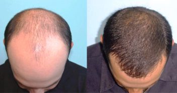 هذا ما يحدث للأصلع بعد عملية زرع الشعر – Hair transplant هذا ما يحدث للأصلع بعد عملية زرع الشعر - Hair transplant