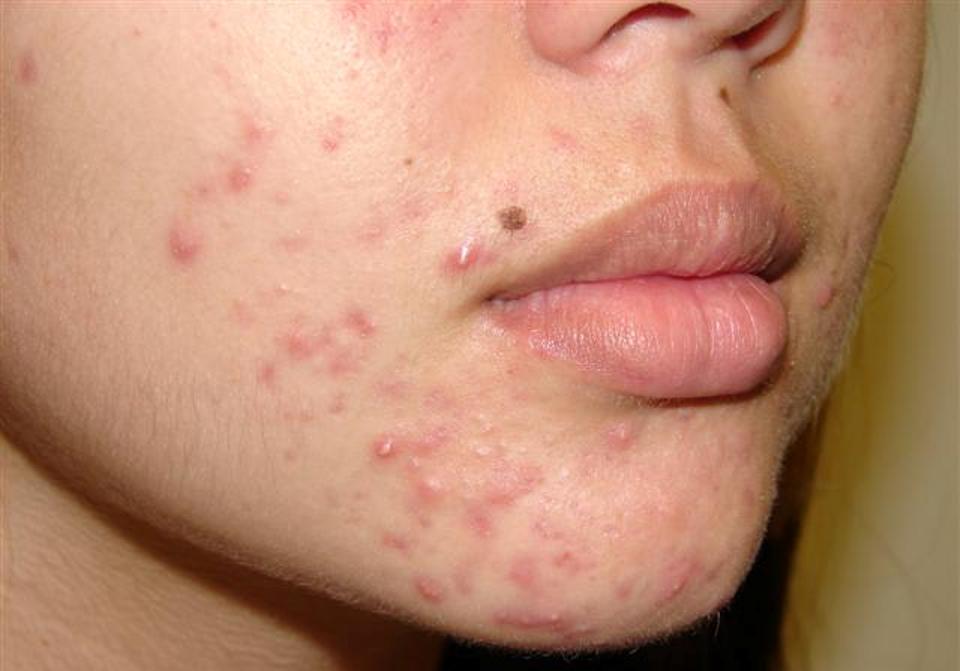 3 طرق بسيط للتخلص من حبّ الشباب acne