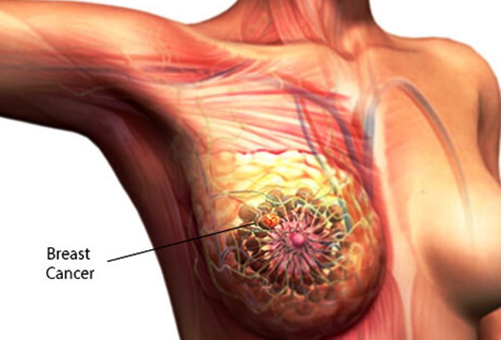 5 أعراض أولية لسرطان الثدي يجب على كل النساء معرفتها