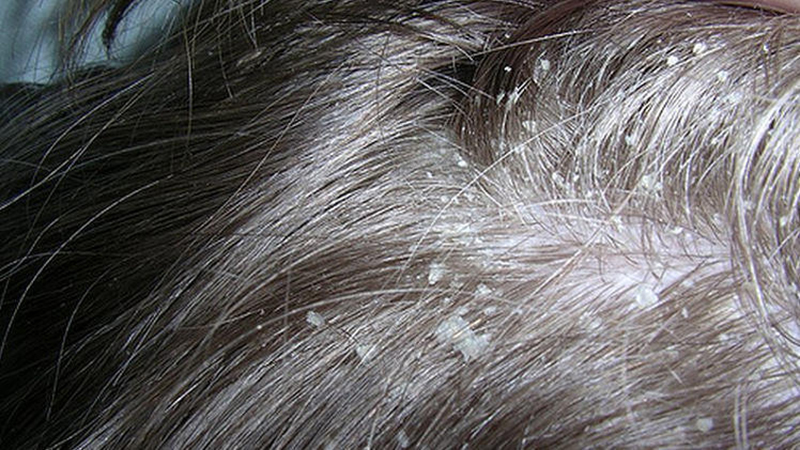 5 نصائح لتخلص من قشرة الشعر