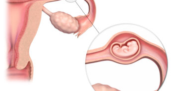 أسباب الحمل خارج الرحم وكيفية علاجه