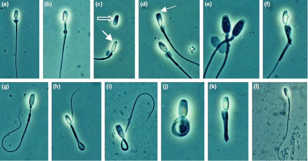 أسباب تشوه الحيوانات المنوية التي يغفل عنها الرجال