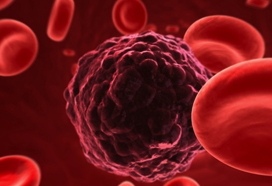 أسباب وأعراض وعلاج سرطان الدم “اللوكيميا”