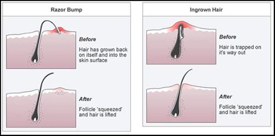 إحذر هي الأخطاء لتجنب نمو الشعر تحت الجلد