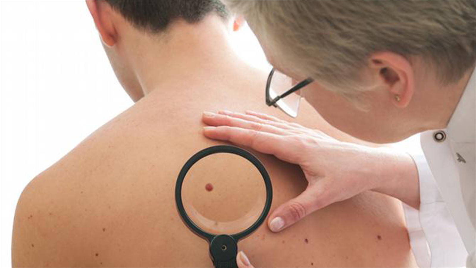 الشامة .. قد تكون من مسبّبات سرطان الجلد في حوالي 50% من الحالات!