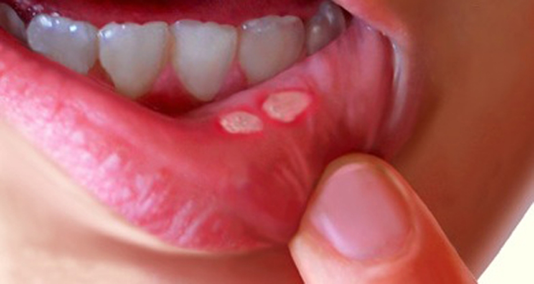 علاج قرحة الفم واستشارة الطبيب
