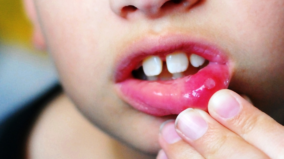 علاجات منزلية فعالة لقرح الفم دون الحاجة إلى طبيب