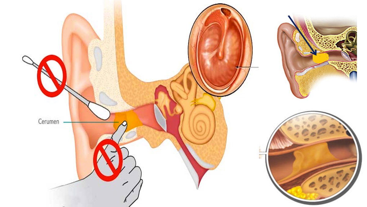 فائدة شمع الأذن وأخطار تنظيفه بأعواد القطن