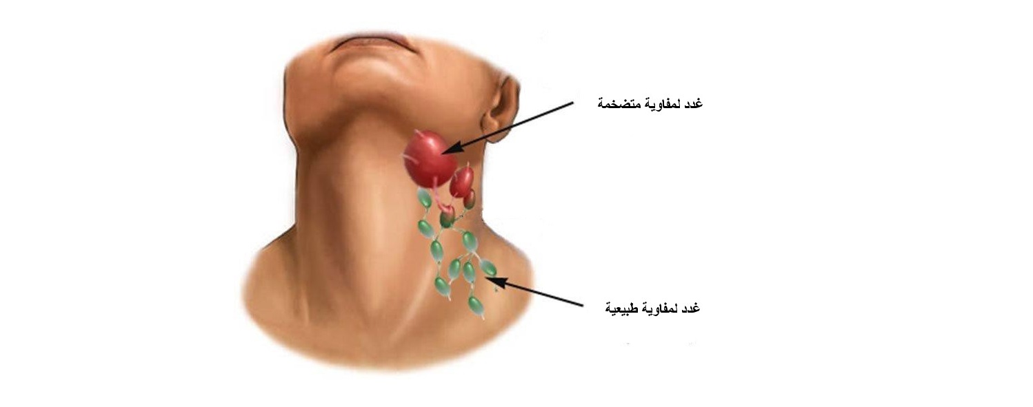 هذا كل ما تريد معرفته عن أورام وكتل الرقبة أو العنق