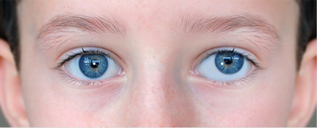 ما هي أسباب انحراف العين؟ وماهي طرق علاجها؟