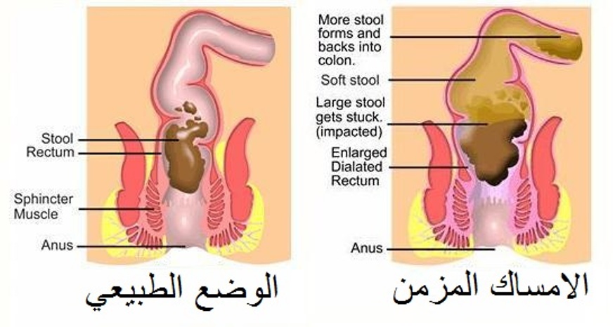 معالجة الامساك بوصفات منزلية بسيطة