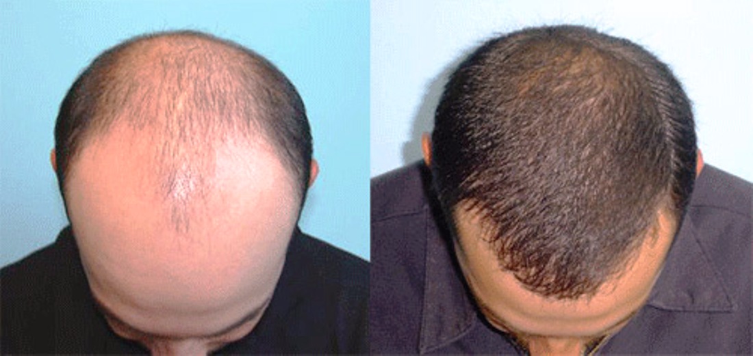 هذا ما يحدث للأصلع بعد عملية زرع الشعر – Hair transplant