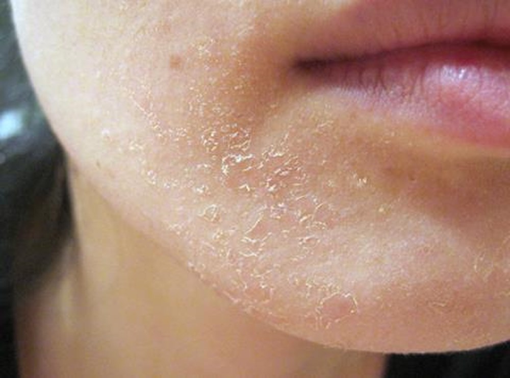 هل لجفاف الوجه علاقة بتوعّك المعدة؟